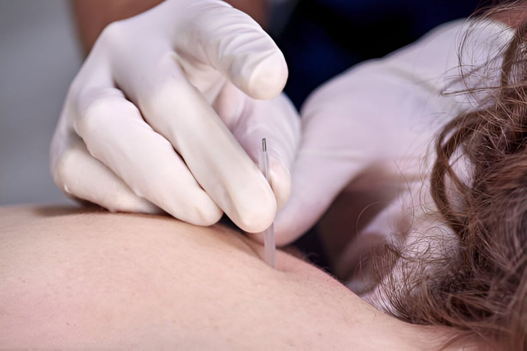 Acupunctuur bij chronische lage rugpijn: helpt het?