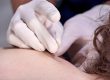 Dry needling in de nek- en schouderspieren