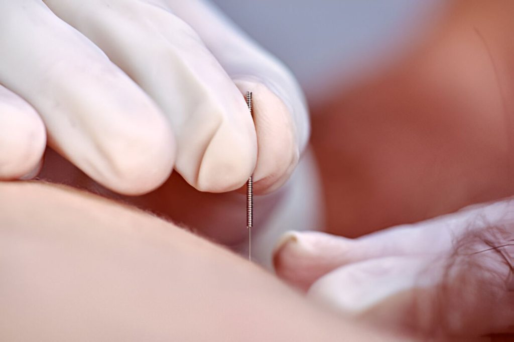 Is acupunctuur veilig? Dit zegt groot onderzoek