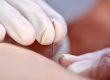 Dry needling met een dunne naald