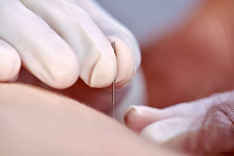 Is acupunctuur veilig? Dit zegt groot onderzoek