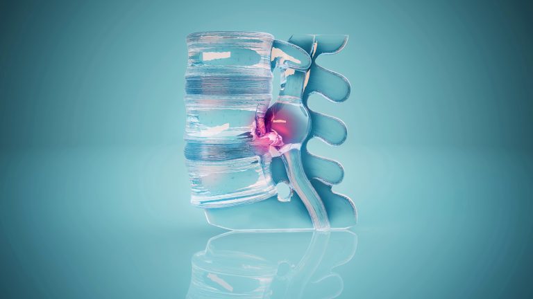 Focused shockwavetherapie (ESWT) bij chronische lage rugpijn uit de facetgewrichten