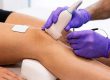 EPTE-behandeling van de patellapees