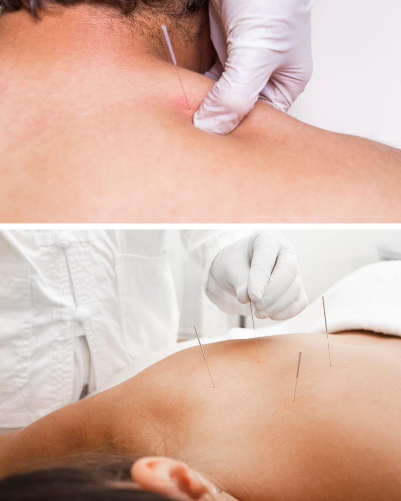 Dry needling in schouder en rug