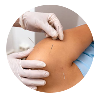 Dry needling
